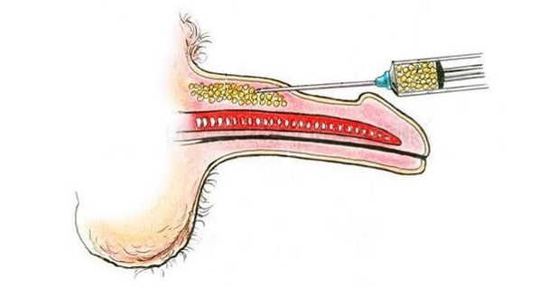Hyaluronsäure -Injektionen im Lauf eines Mitglieds, um es zu erhöhen